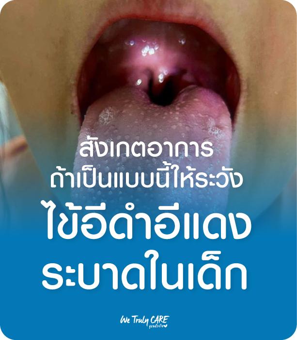 เตือนไข้อีดำอีแดงระบาดในเด็ก สังเกตอาการแบบนี้ เตรียมรับมือ